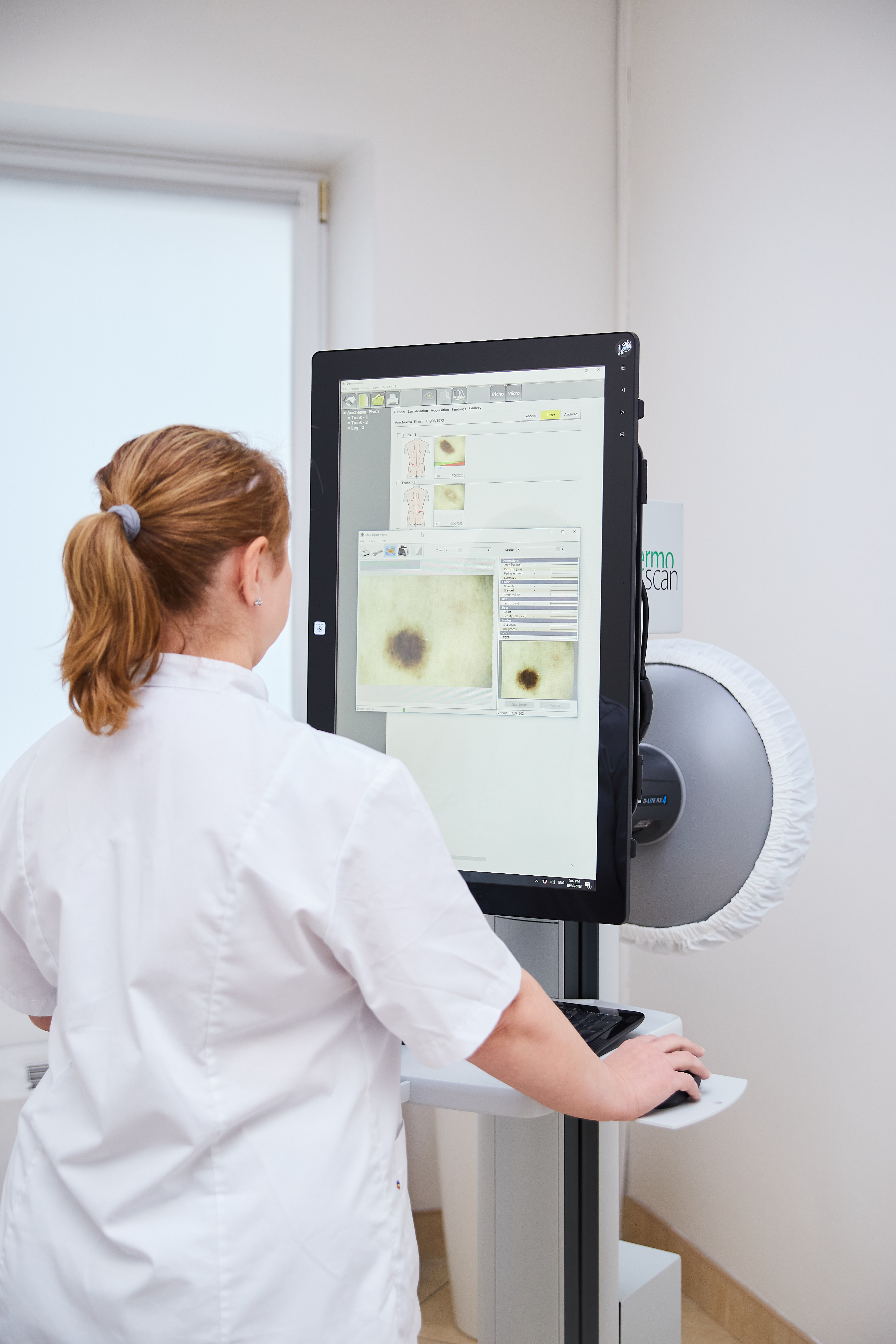 Dermatoscopia alunițelor